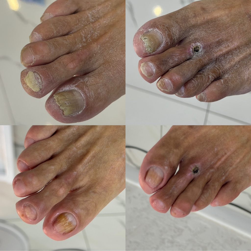 Обработка 10 повреждённых ногтей с видоизменениями, 14.000-22.000