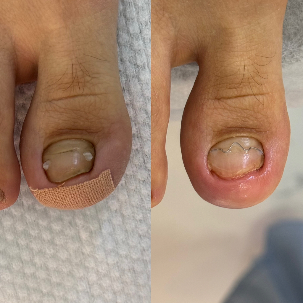 Коррекция MBrace, скоба 3ТО , скоба Фрезера, титановой нити (2 единицы).  Стоимость - 25.000 тенге.