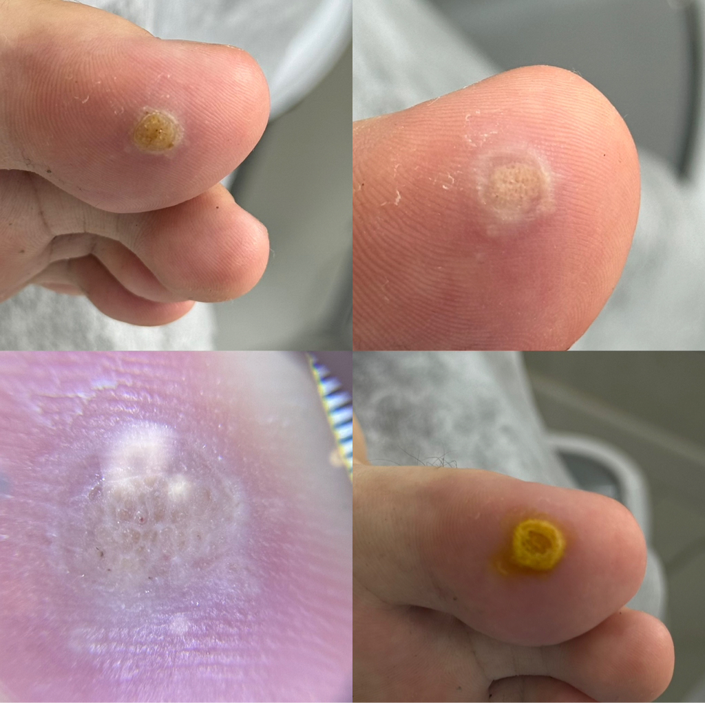 Выведение бородавки за 1 единицу.  Стоимость - 7000 тенге.  Несколько единиц - от 10.000-20.000тенге.