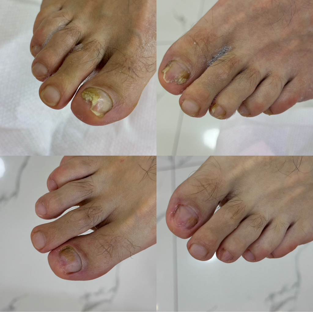 Зачистка онихогрифоза/онихомикоза  10 ногтей. Стоимость - 14.000-20.000 тенге.  Цена зависит от сложности