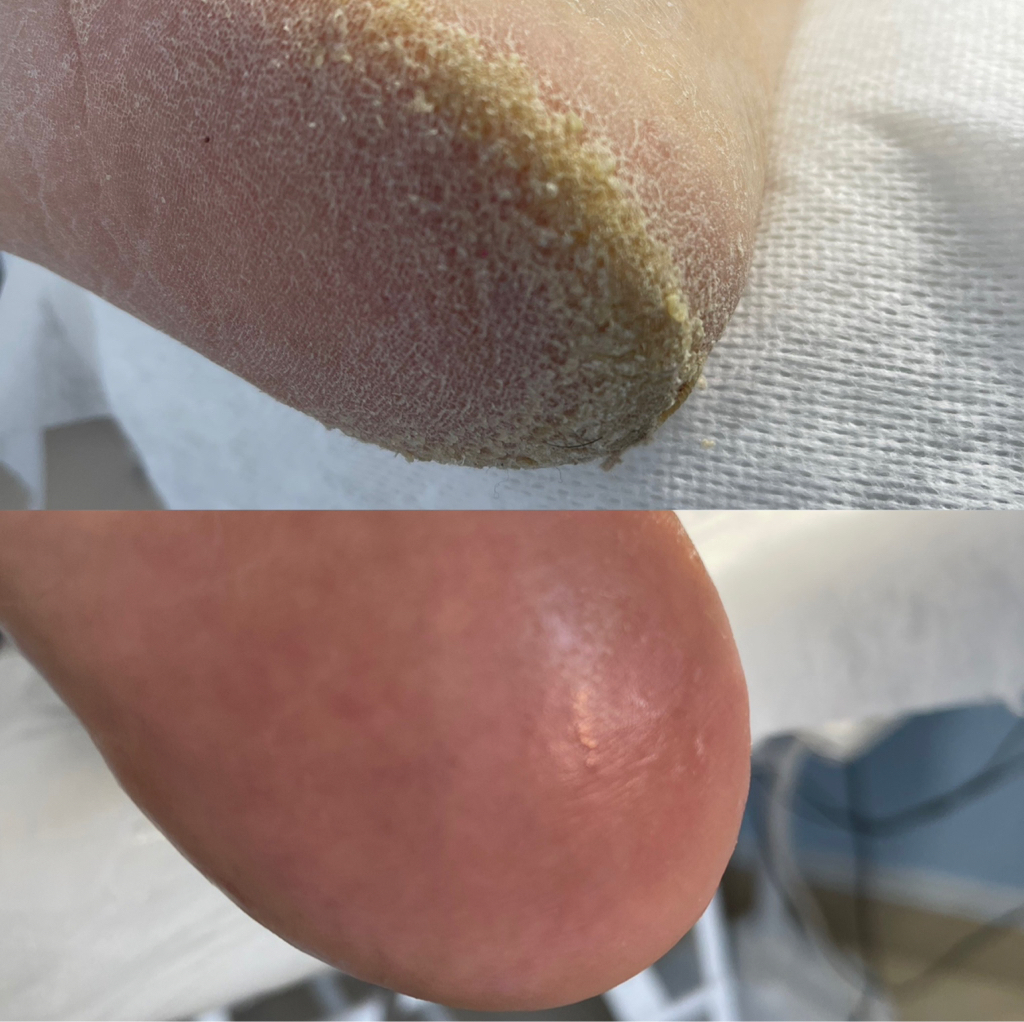 Обработка стоп ( трещины, натоптыши, гиперкератоз). Стоимость - 10.000 - 25.000 тенге.  Цена зависит от сложности проблемы.