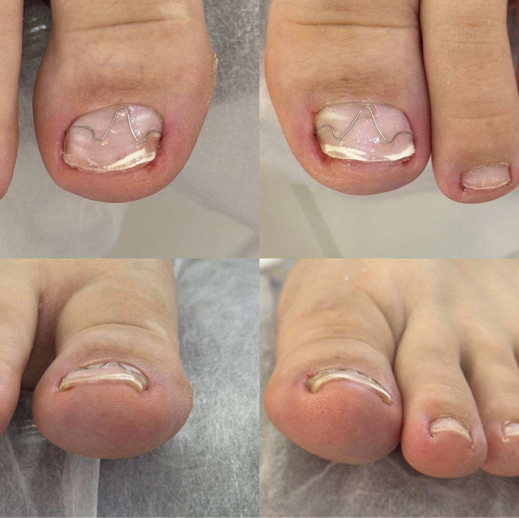 Установка MBrace, скоба Фрезера , скоба 3ТО  , титановой нити - 1 единица (первая установка).   Стоимость - 20.000 тенге