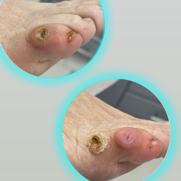 Удаление мозоли.  Стоимость 1 единицы - 7000 тенге, 2-3 единиц от 10.000 и выше.