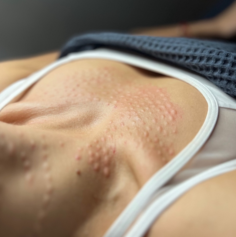 МЕЗОТЕРАПИЯ