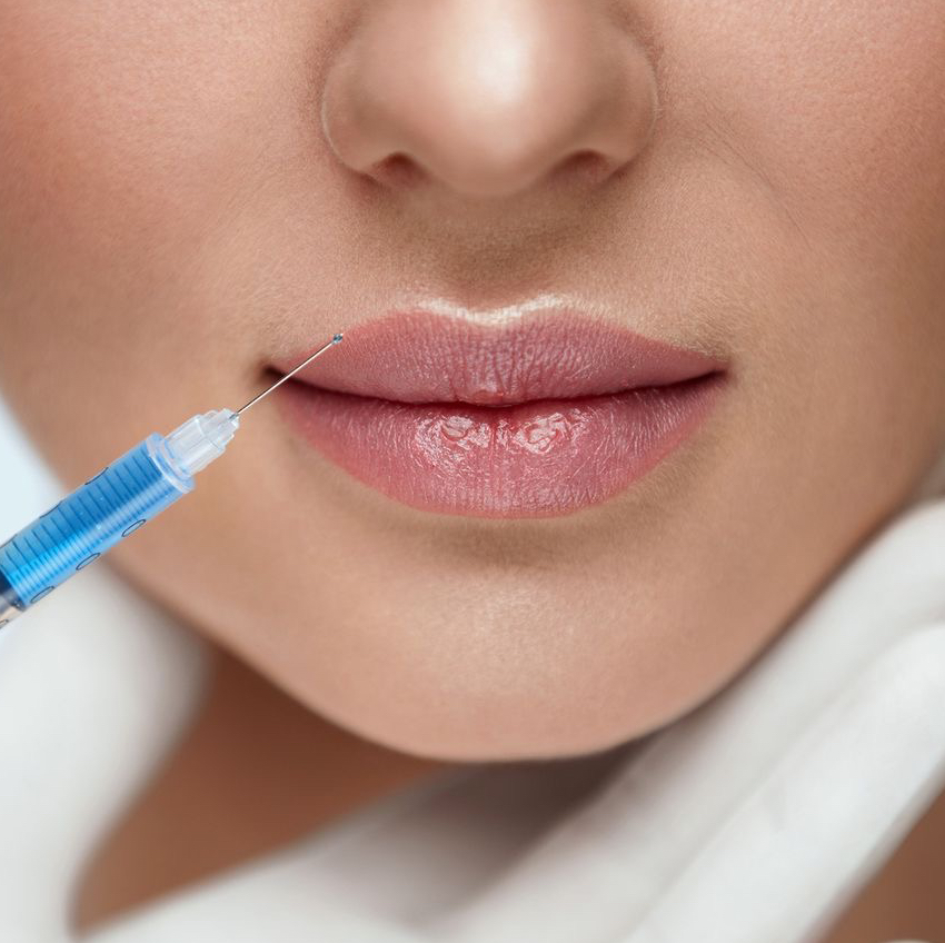 Juvederm ultra 4 1ml