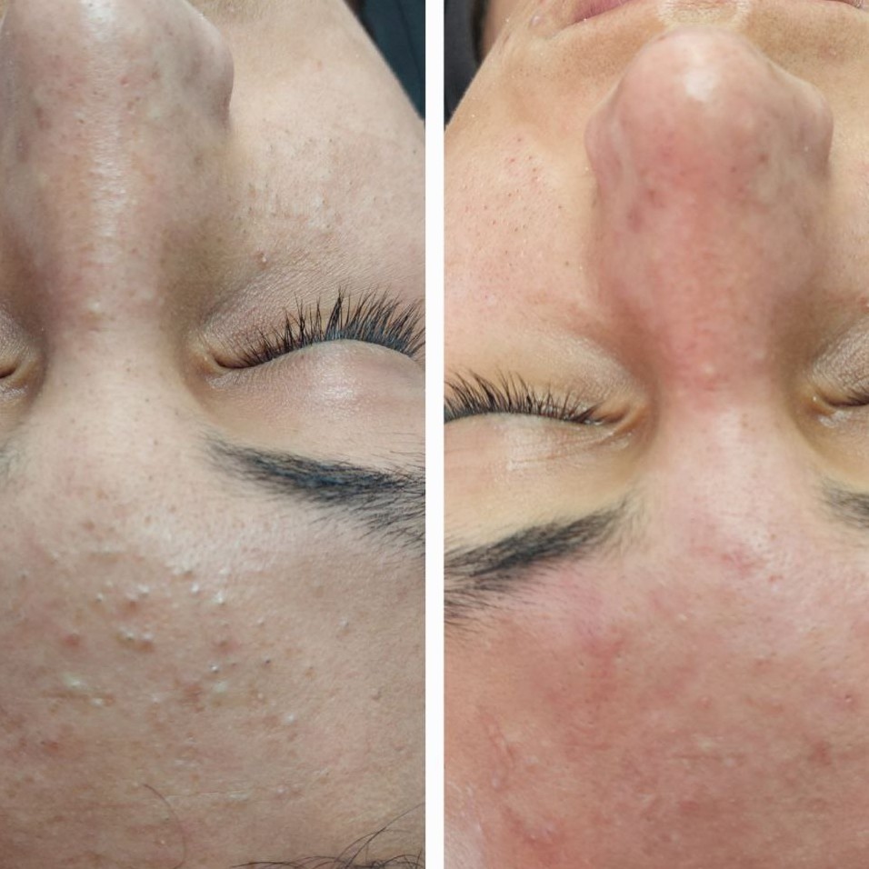 Антикомедонная чистка лица