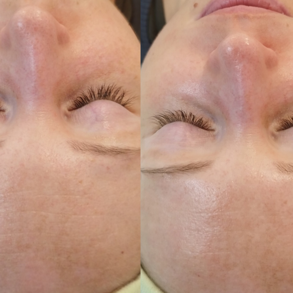 Атравматичная чистка лица при чувствительной коже, куперозе и розацеа (ремиссия)