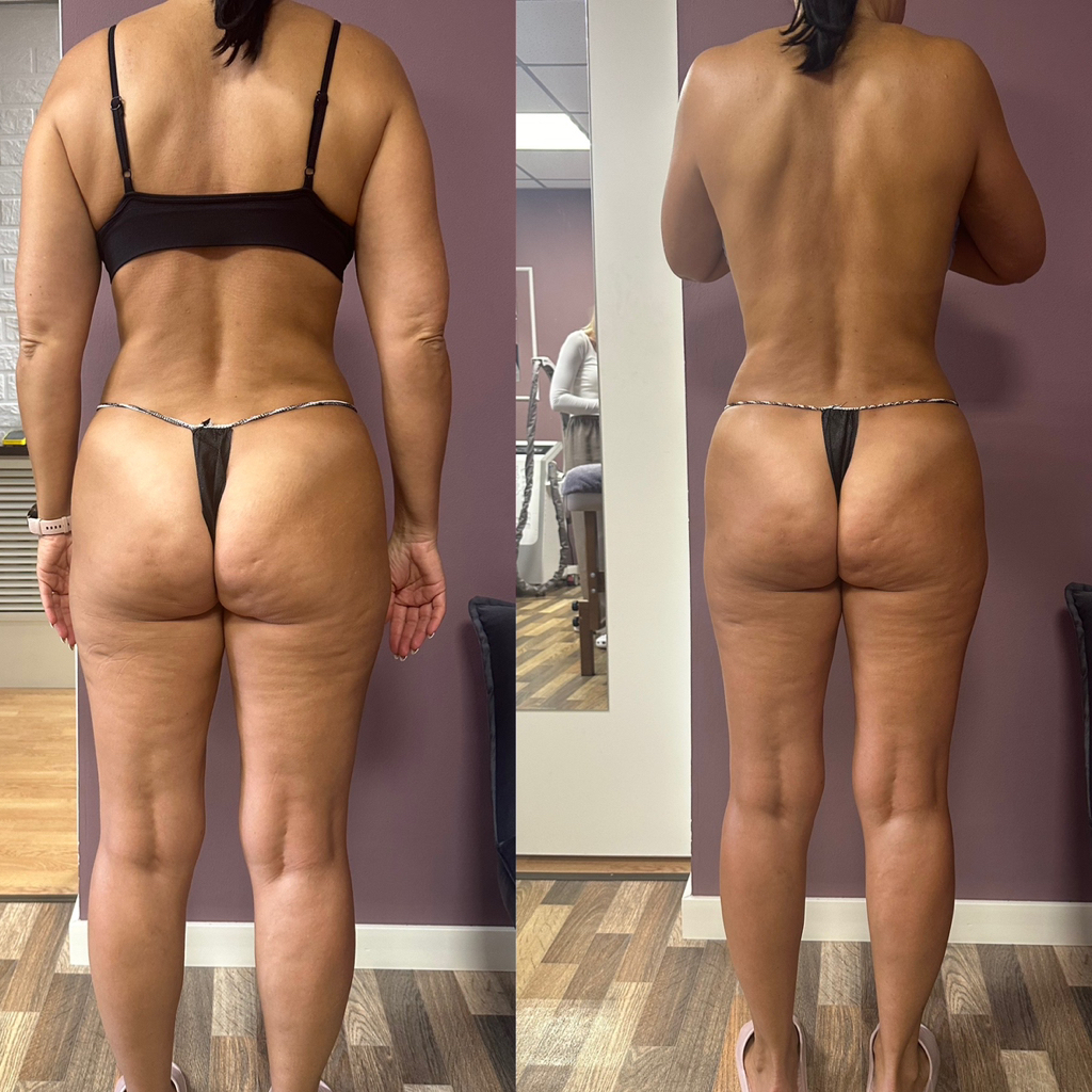 «МИНУС РАЗМЕР» —  lpg+вибромассаж+ручные техники+обертывание