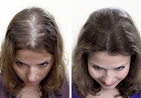 Мезотерапия волосистой части кожи головы (от выпадения) препарат dermaheal/ fusion