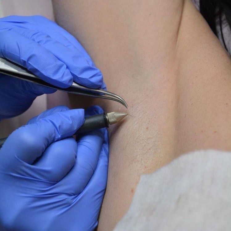 Электроэпиляция