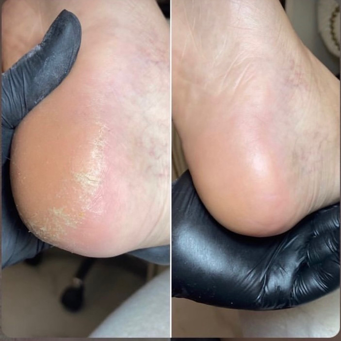 Педикюр ( аппаратный, SMART )