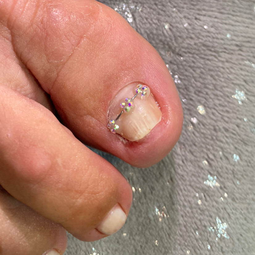 Установка титановой нити 1 ноготь