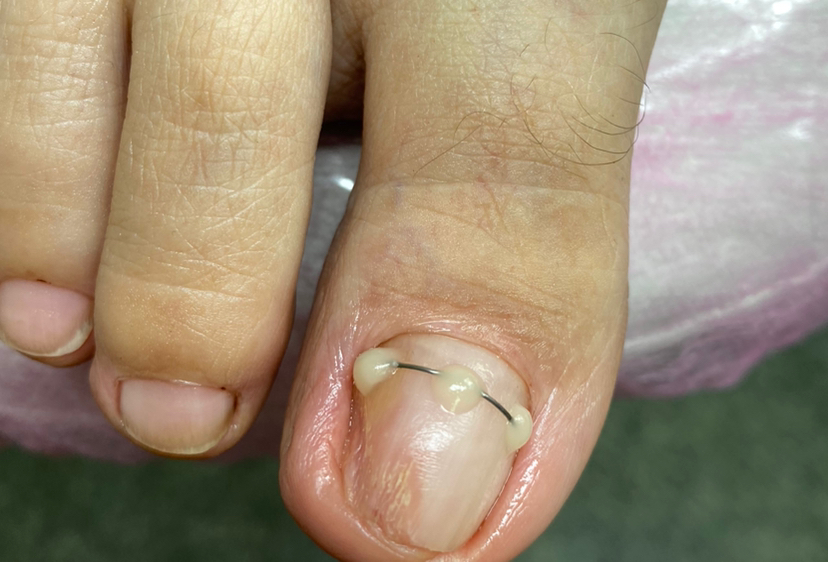 Установка титановой нити 2 ногтя