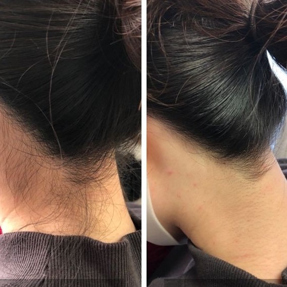 Окантовка волос на шее