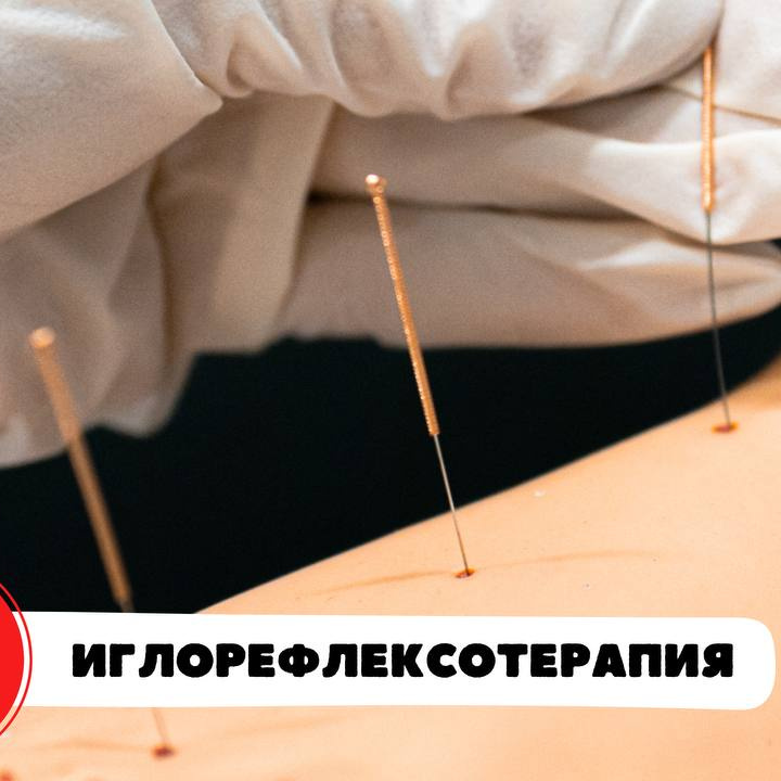 Иглоукалывание 