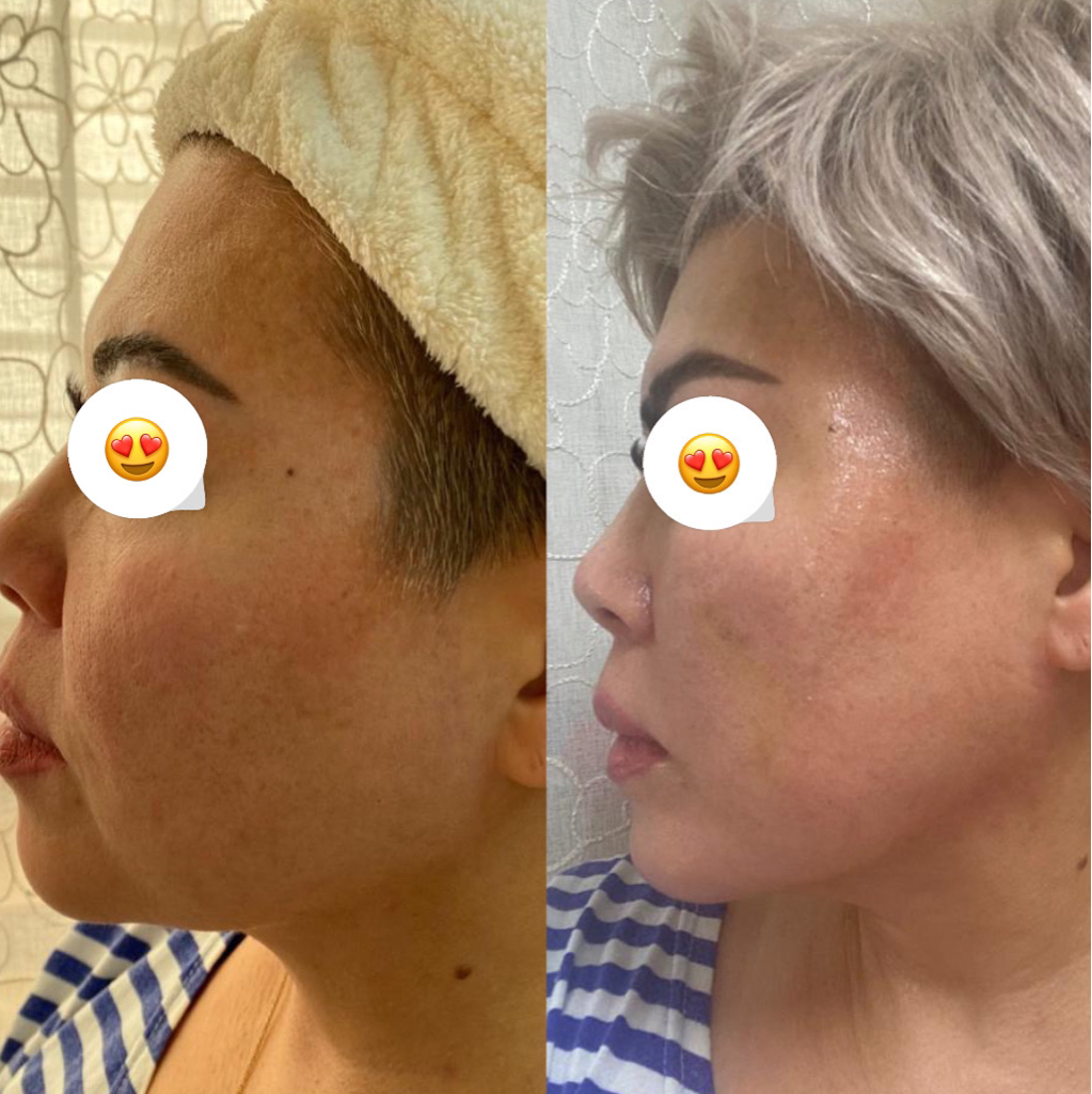 Коллагенстимуляция RADIESSE