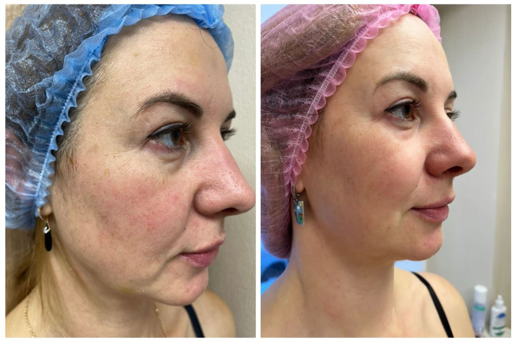 Коллагенстимуляция ELLAGEN( полимолочная кислота)