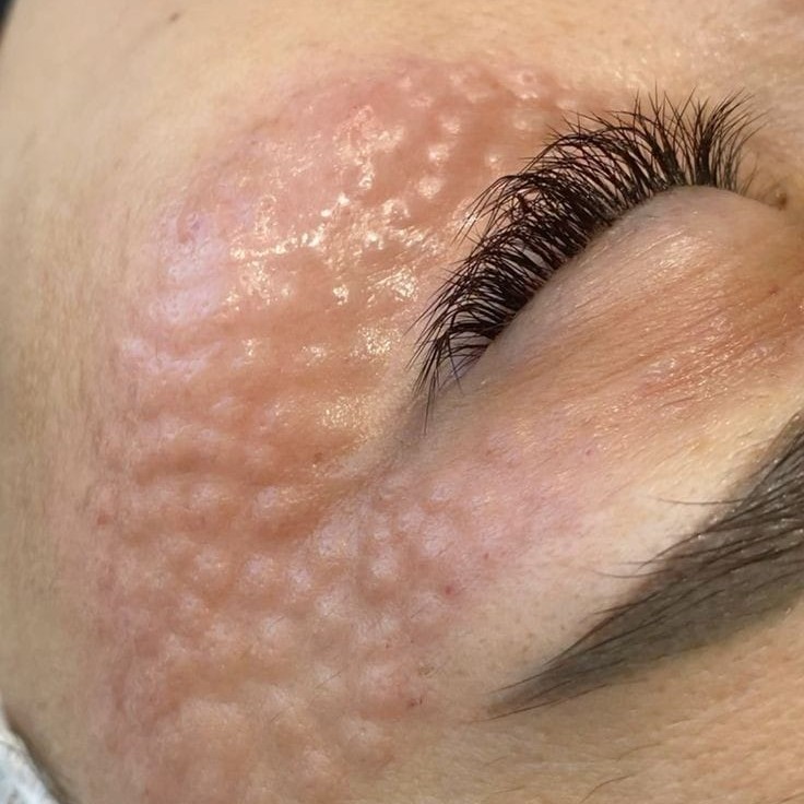 Мезотерапия