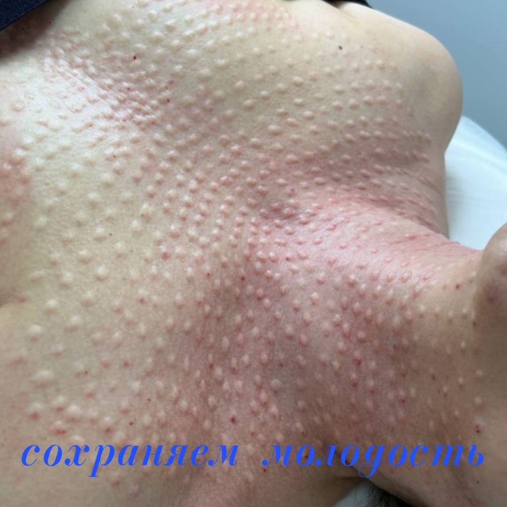 Биоревитализация одним препаратом