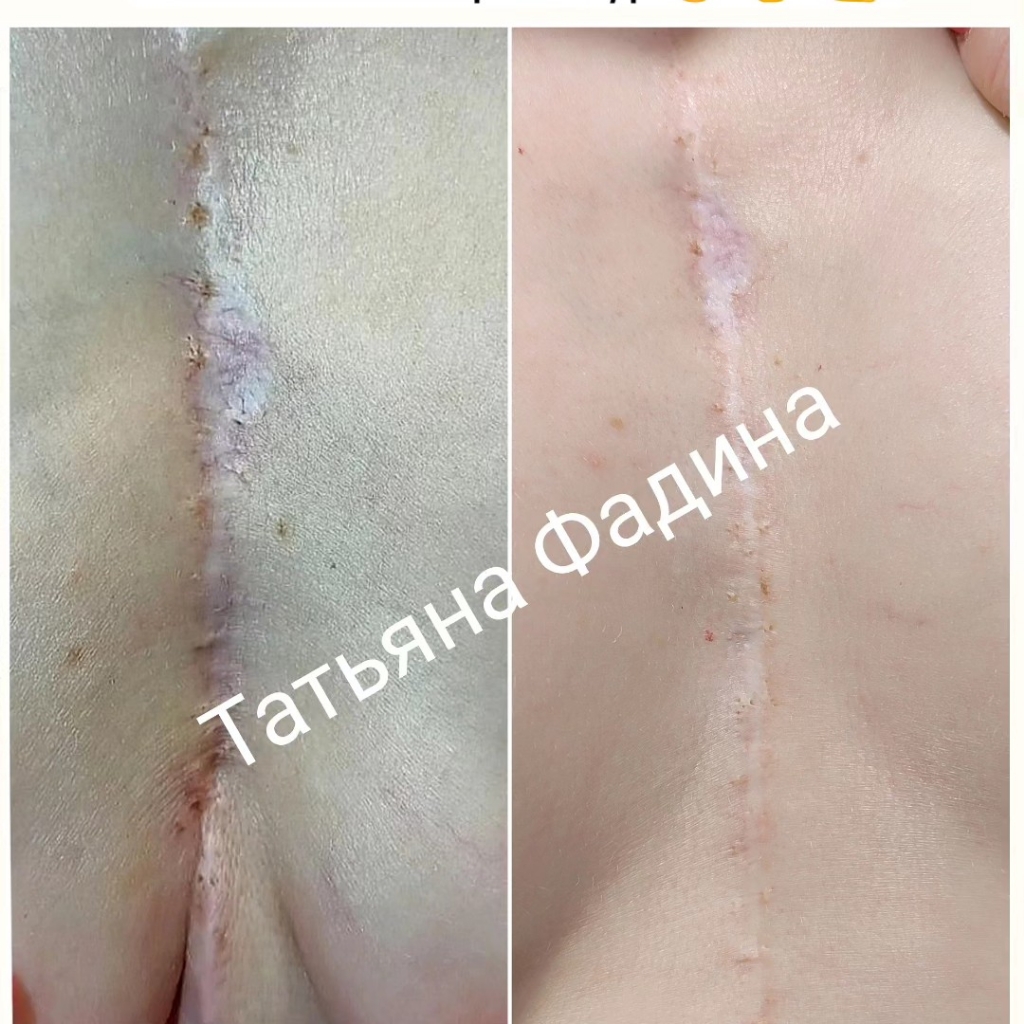 Шрамы коррекция