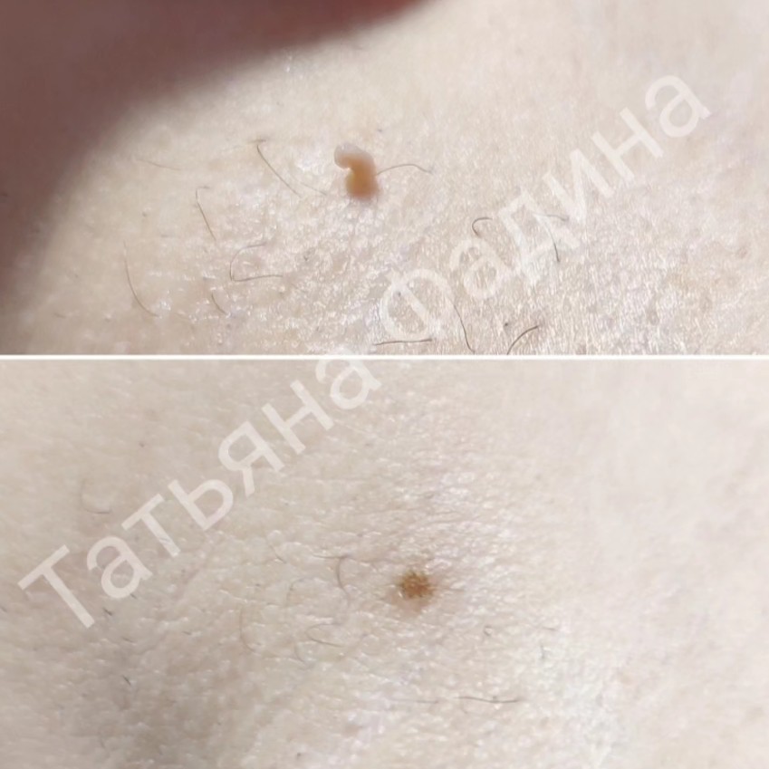 Кератомы, ангиомы, папилломы, гиперплазия ХП