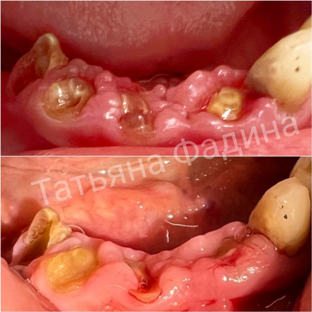 Восстановление слизистой ротовой полости