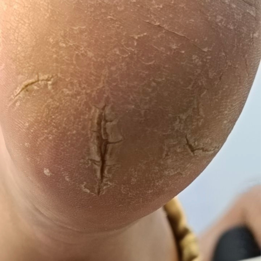 Обработка трещин