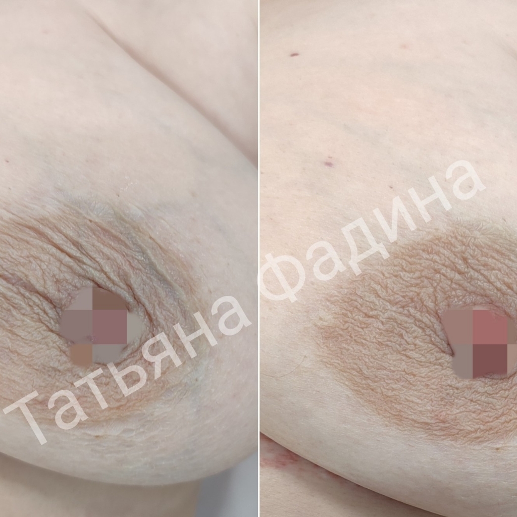 Подтяжка груди