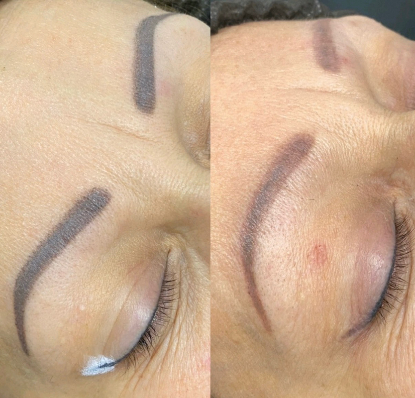 Осветление татуажа ремувером