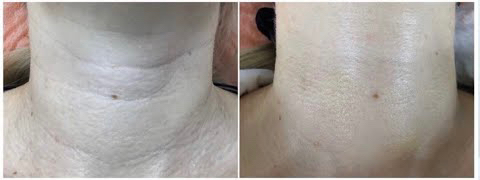 Заполнение колец Венеры