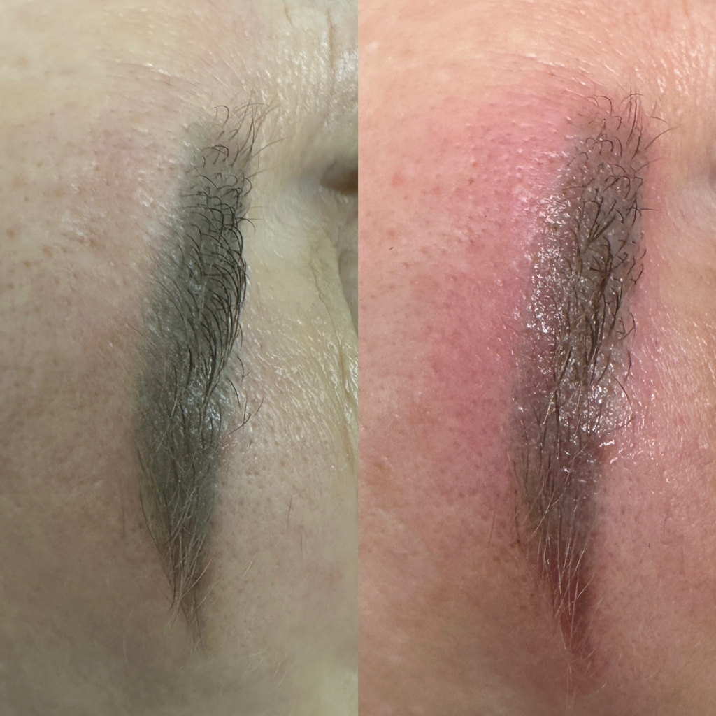 Удаление старого татуажа ремувером