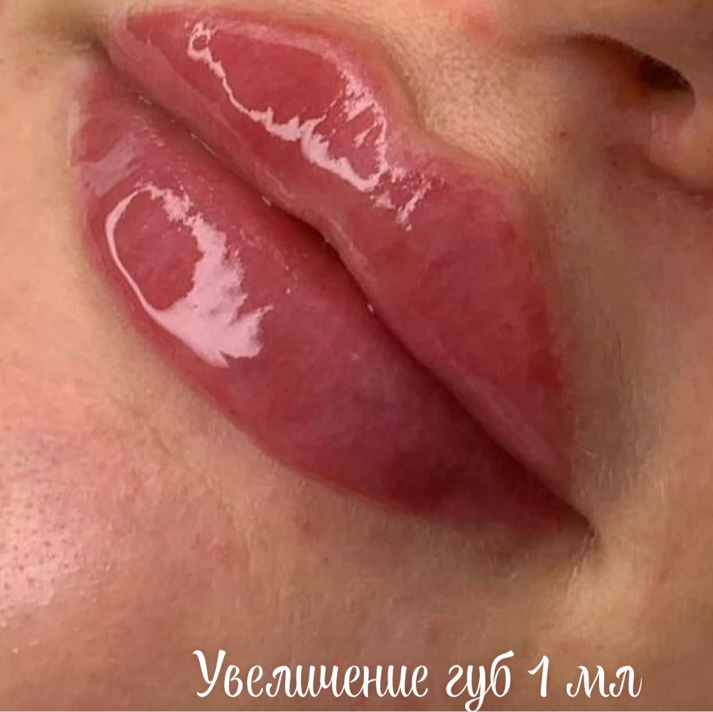 Увеличение губ