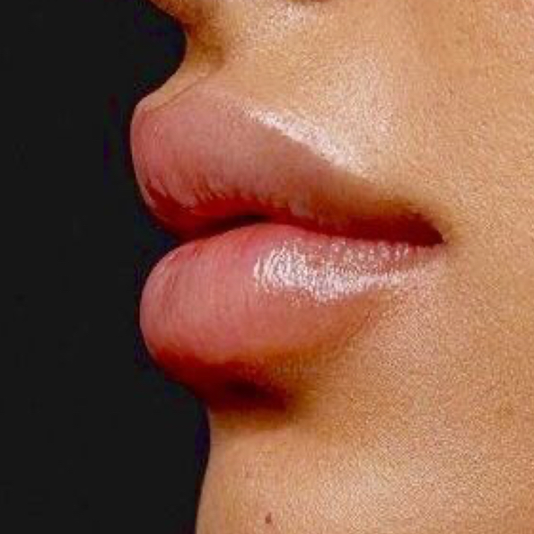 Лазерная эпиляция «верхняя губа»