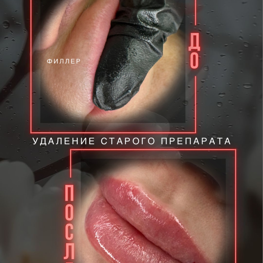 Лонгидаза