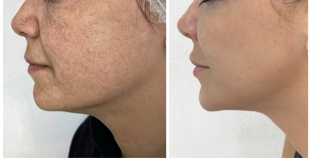 BRILIANCE THERAPY  M22 ( dark spot laser) + DARK SPOT  ( derma-pen  brightening mesotherapy)