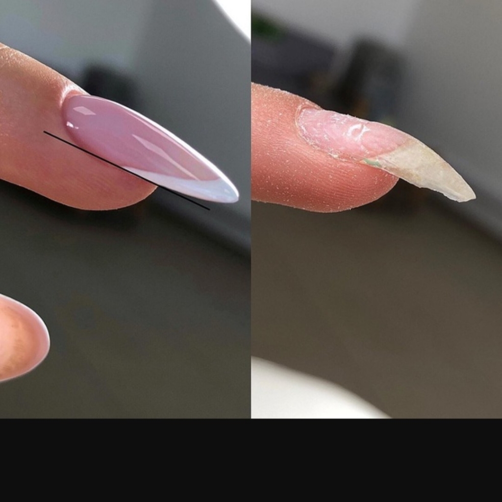 Поднятие клюющих ногтей