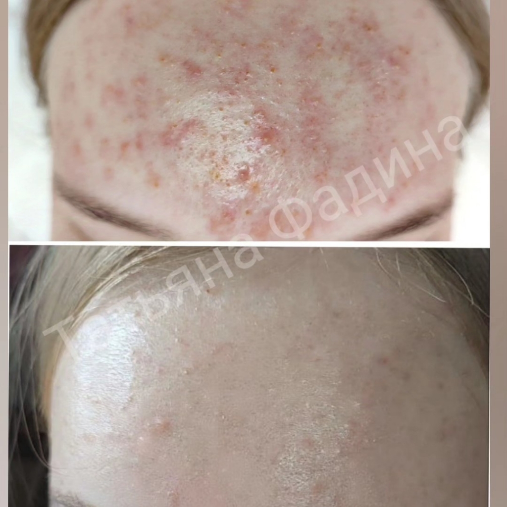 Акне локально