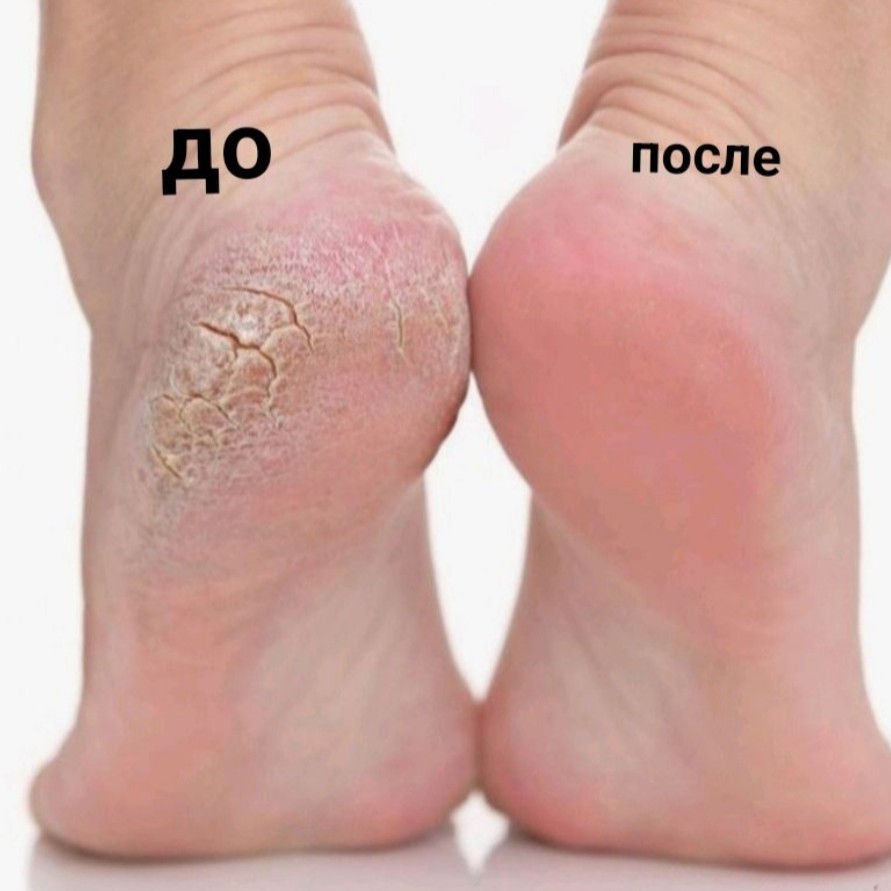 Педикюр Аппаратный