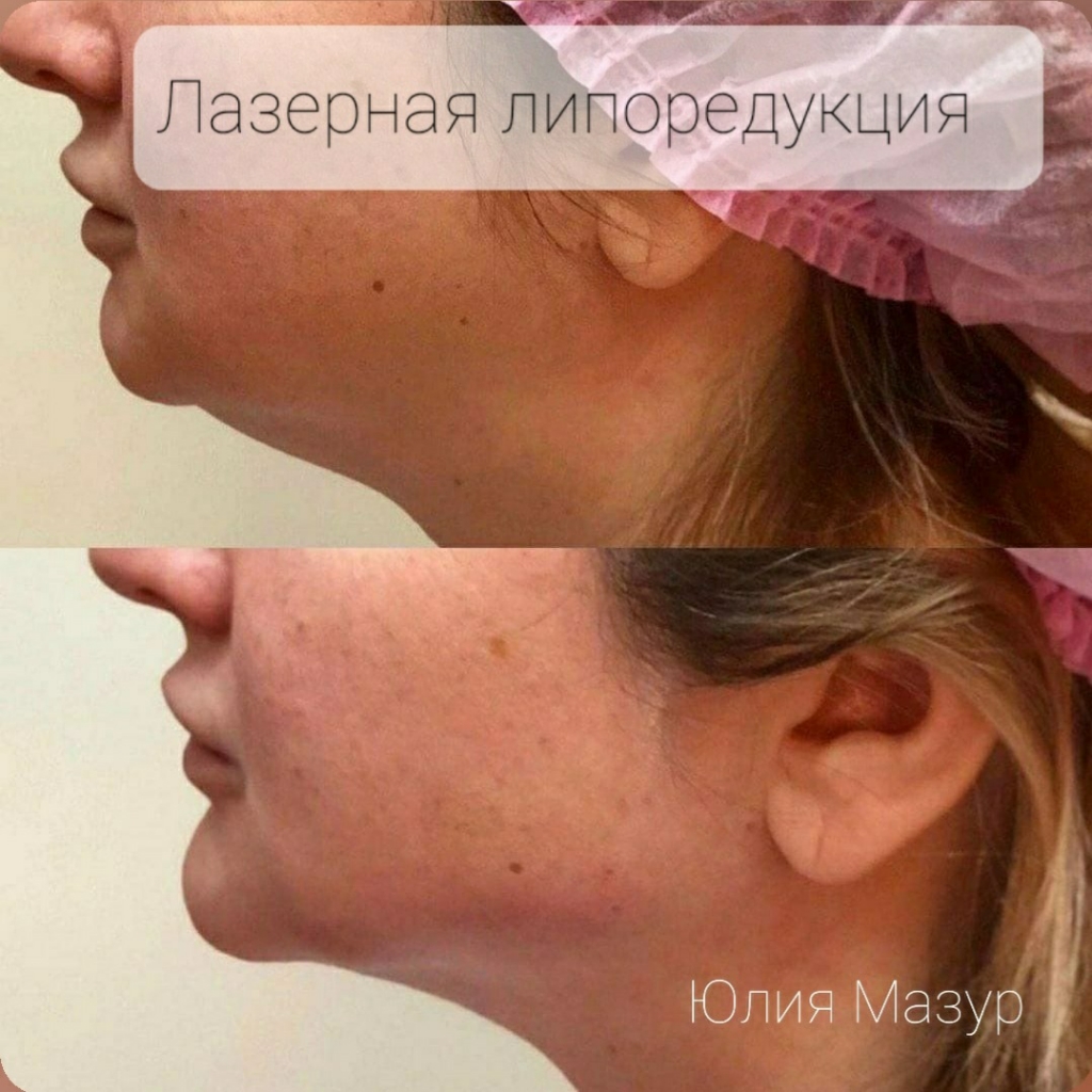 Лазерная липосакция (подбородок)