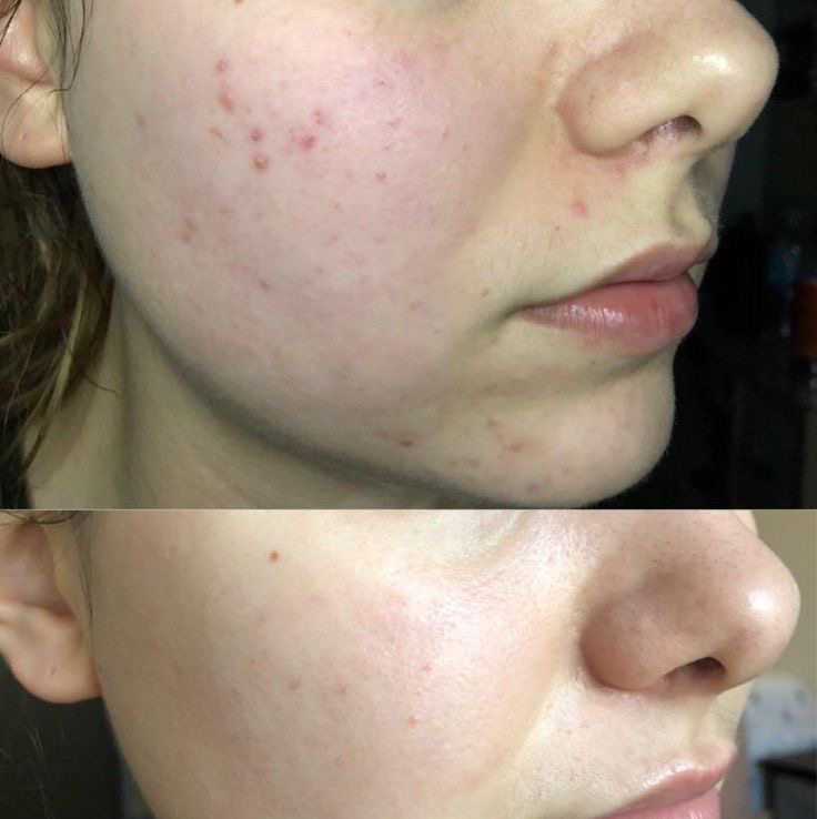 Пилинг всесезонный «ACNE THERAPY