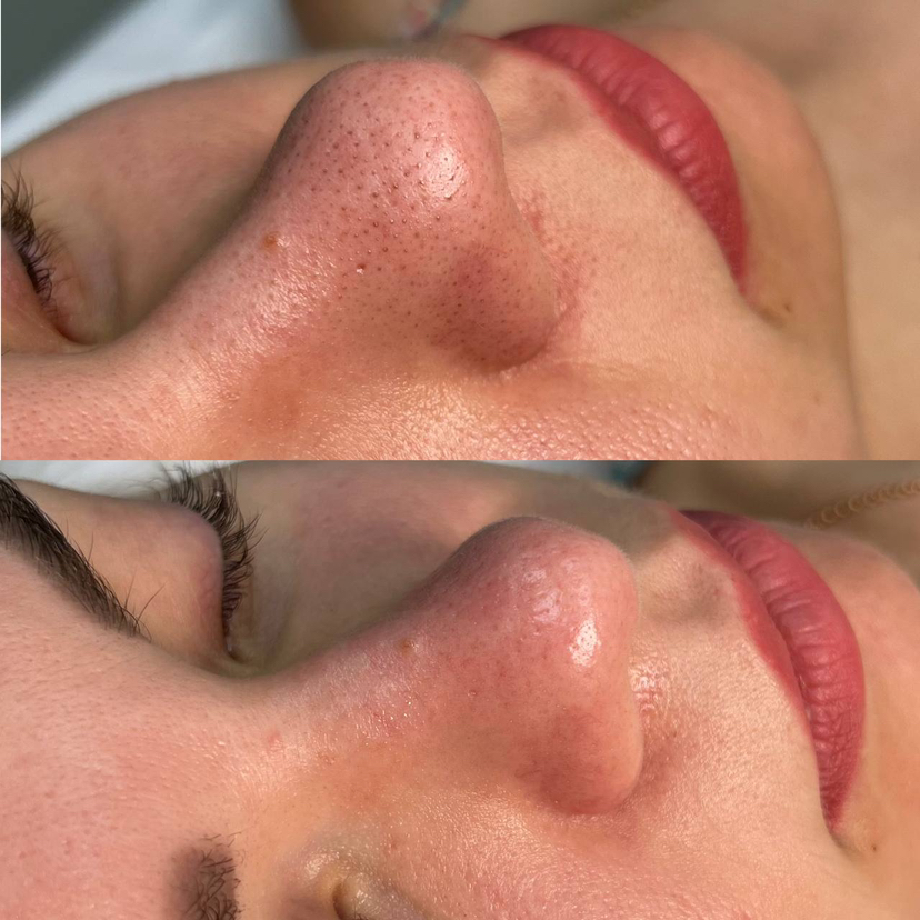 Чистка лица