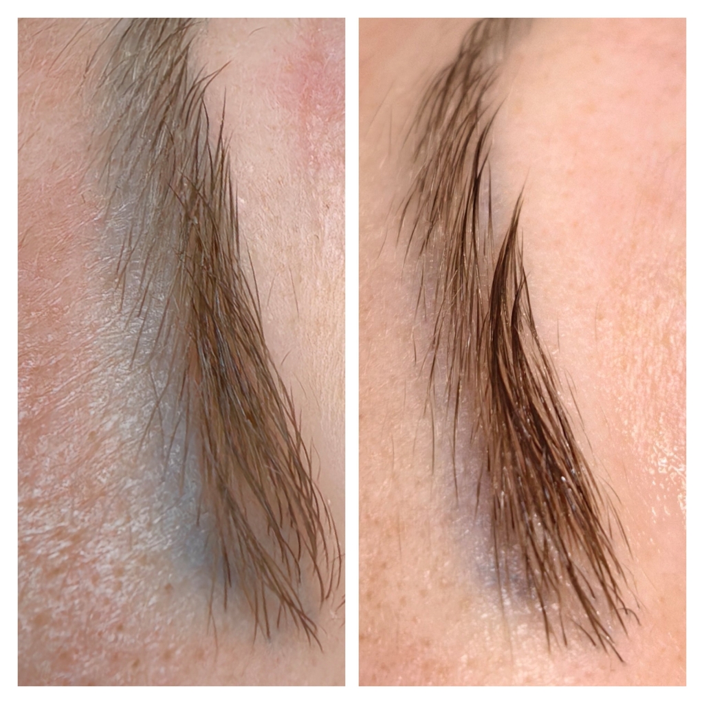 Удаление перманентного макияжа