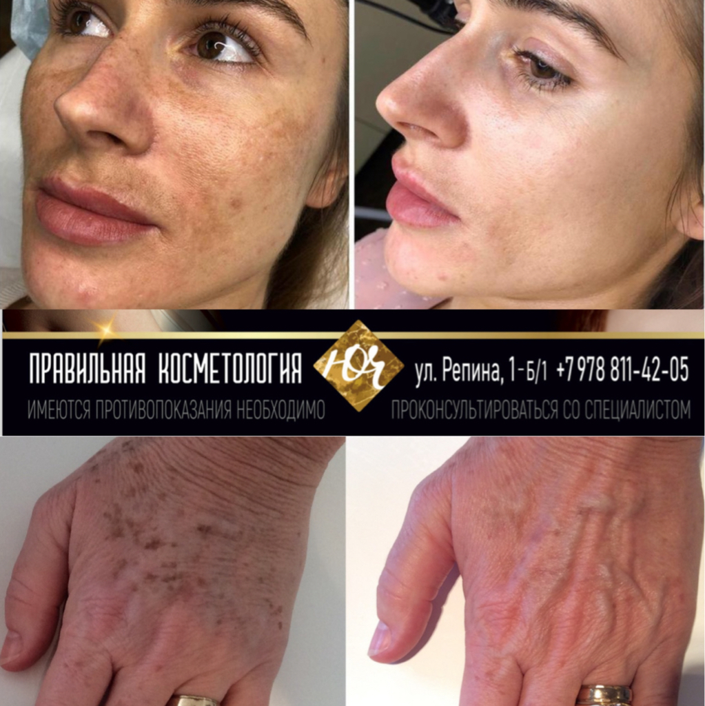 Консультация LUMECCA