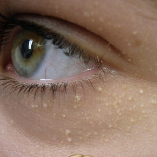 Просянки,Милиумы,Жировики.