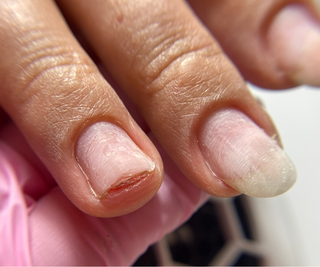 Ремонт ногтя