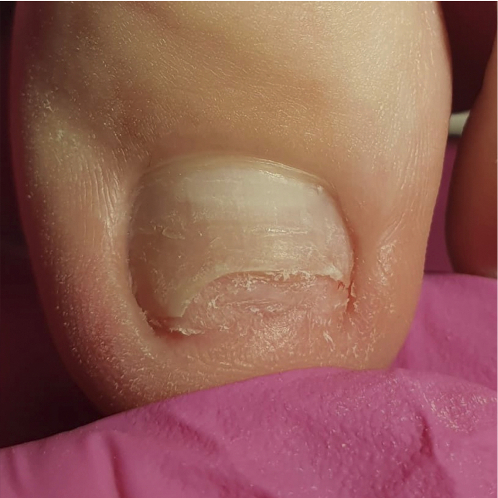 Зачистка  онихолизиса. 1 палец руки -100  1 палец ноги -250