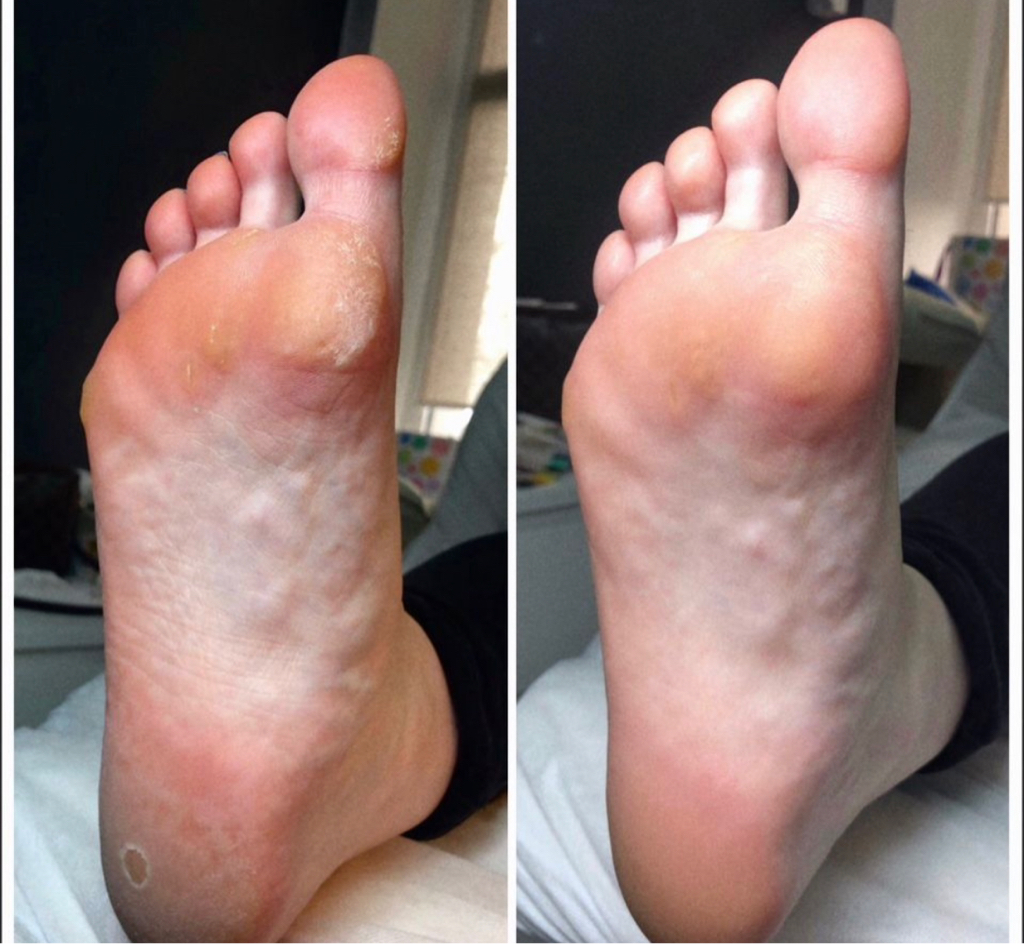 Гигиенический   педикюр