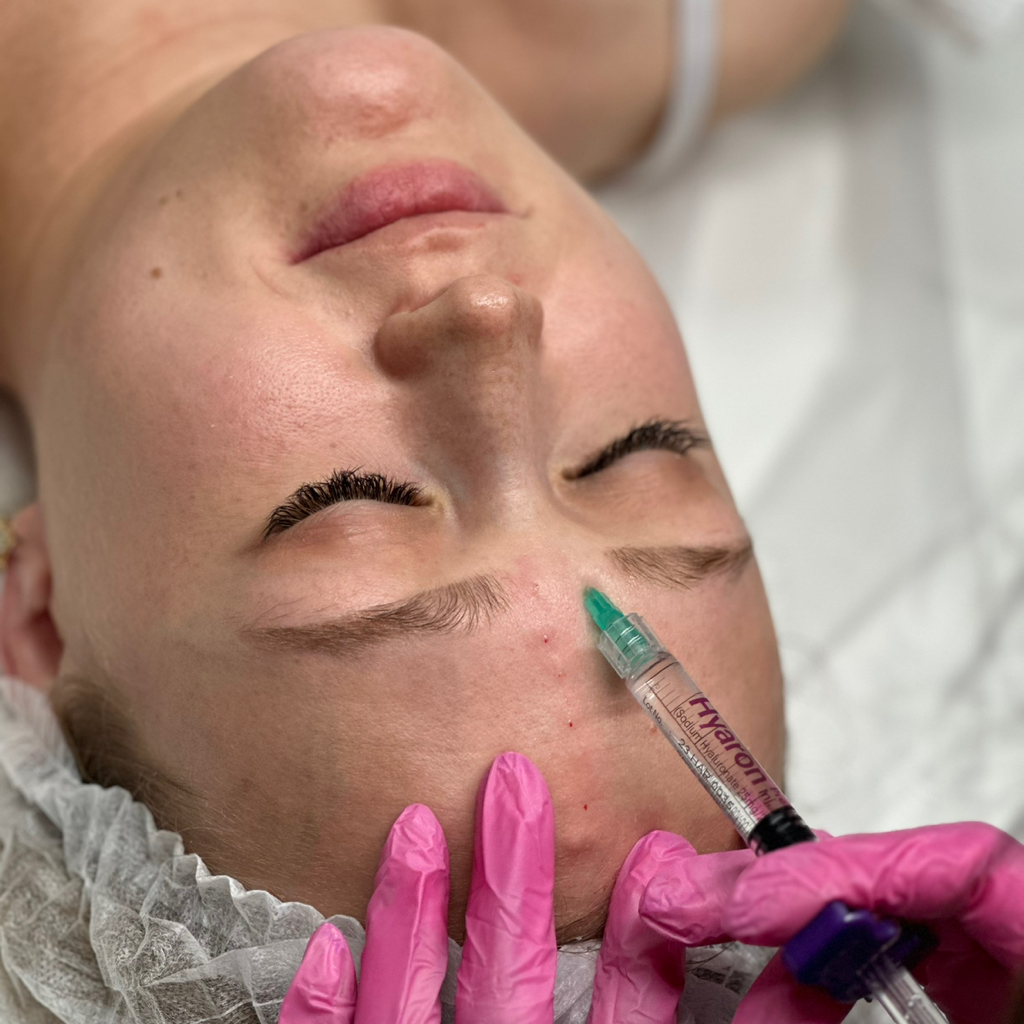 Биоревитализация лица Dermaheal