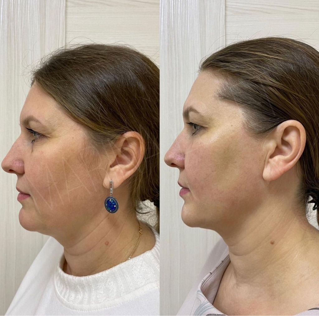 Авторский массаж лица