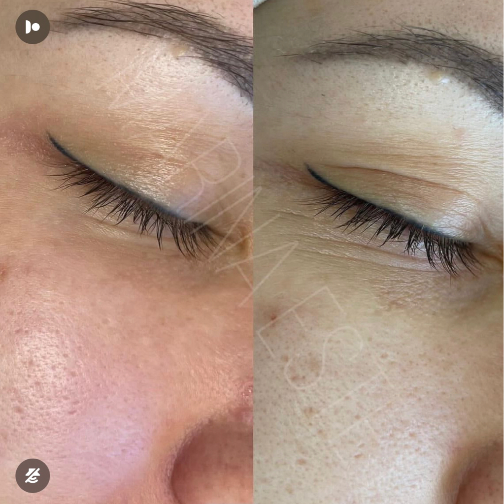 Биоревитализация  глаз